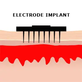 Electrode Implant